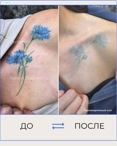 Удаление татуировки